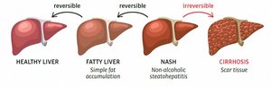 Progression of liver disease
