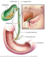 Gallstones and bile ducts