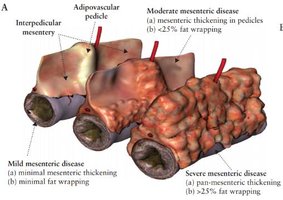 Mesenteric disease severity
