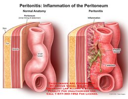 Peritonitis: inflammation of the peritoneum