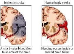 Ischemic and hemorrhagic stroke
