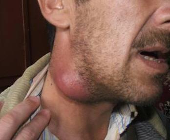 Swollen lymph node in the neck