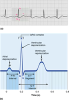 ECG tracing with labeled waves and intervals