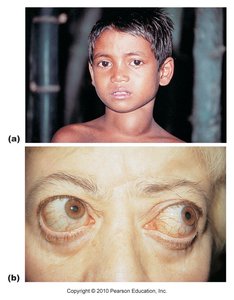 Images showing goiter and exophthalmos in Grave's disease