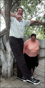 Image of a person with gigantism
