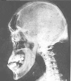 X-ray showing acromegaly (thickened jaw and brow)