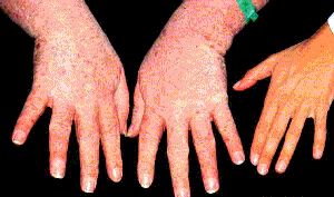 Image showing enlarged hands in acromegaly