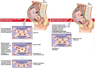 Hemolytic disease of the newborn