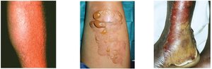 Images of first, second, and third-degree burns