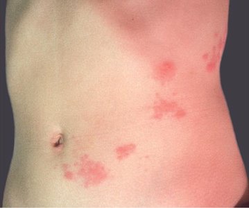 Shingles affecting dermatomes