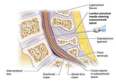 Lumbar puncture needle entering subarachnoid space