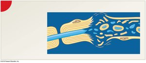 Fragmentation of axon and myelin after injury