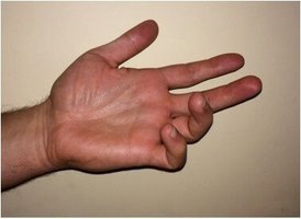 Claw hand due to ulnar nerve injury