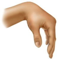 Wrist drop due to radial nerve injury