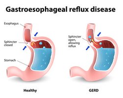Diagram of GERD showing reflux of stomach acid into esophagus