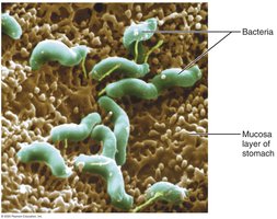 Helicobacter pylori bacteria in the stomach mucosa