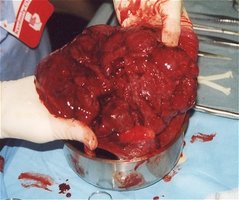 Placenta