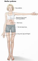 Marfan syndrome symptoms diagram