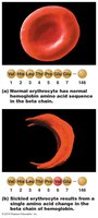 Sickle cell anemia: normal vs. sickled erythrocytes