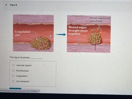 Clot retraction: serum squeezed out, wound edges brought together
