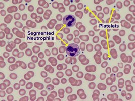 Normal blood smear with red blood cells, segmented neutrophils, and platelets