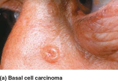 Basal cell carcinoma