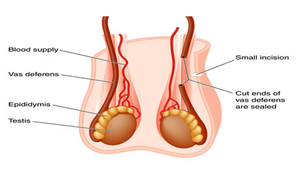 Vasectomy procedure diagram