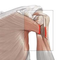 Torn pectoralis major muscle