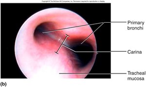 Endoscopic view of the carina and primary bronchi