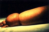Severe lymphedema of the arm