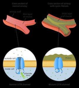 Cystic fibrosis: normal vs mutant CFTR channel and mucus