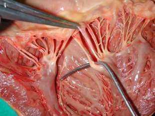 Chordae tendineae and papillary muscles in the heart
