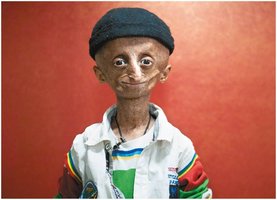 A child with progeria