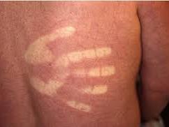Hand with a pale patch (pallor)