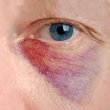 Bruise under the eye