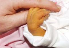 Jaundice in an infant's hand
