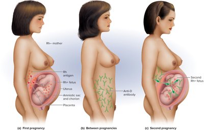 Hemolytic disease of the newborn: Rh incompatibility