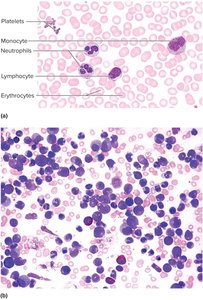 Normal and leukemic blood