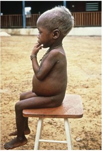 Kwashiorkor: severe protein deficiency