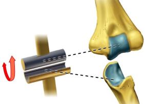 Hinge joint
