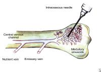 Intraosseous needle placement