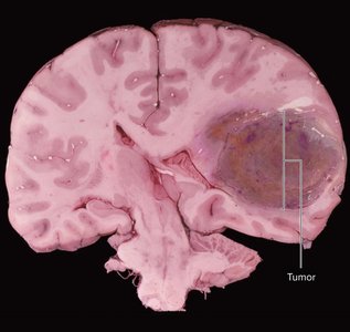 Brain tumor