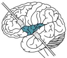 Lateral view of the brain highlighting the central sulcus region