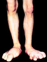 Acromegaly