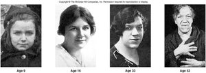 Acromegaly progression