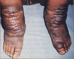 Myxedema
