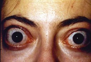Grave's Disease