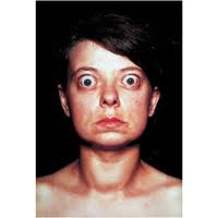 Grave's Disease with exophthalmos