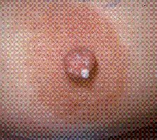 Galactorrhea