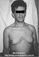 Gynecomastia